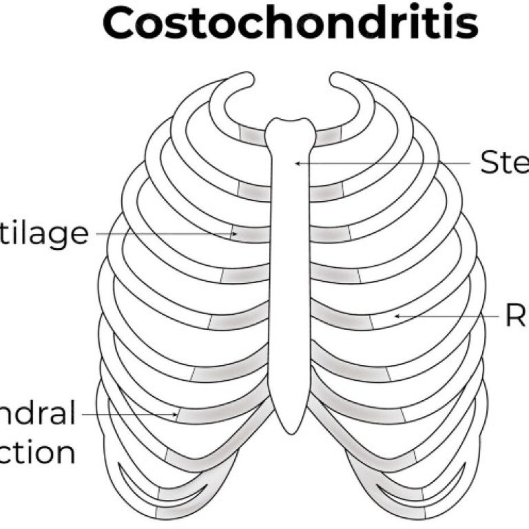 costochondritis picture of ribs - Copy - Copy