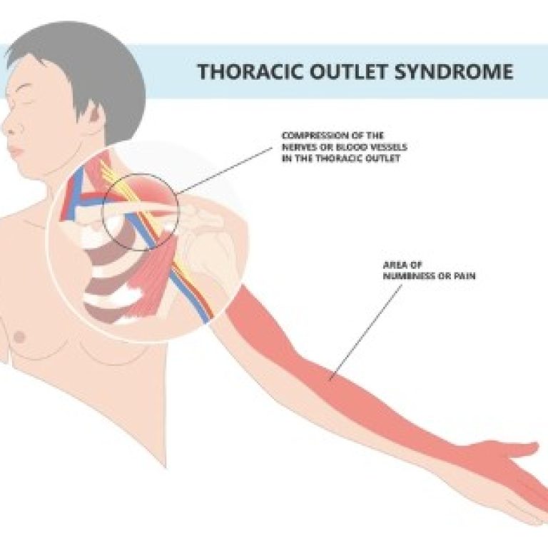thoracic outlet pic